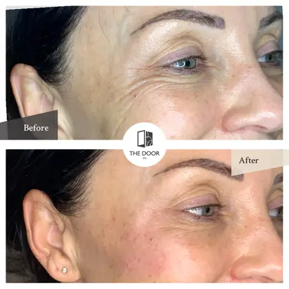 Eye Rejuvenation 1 Before And Afters Copy 2