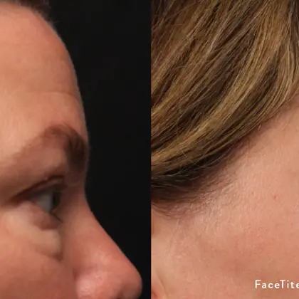 MC FTM8 2E Upperface