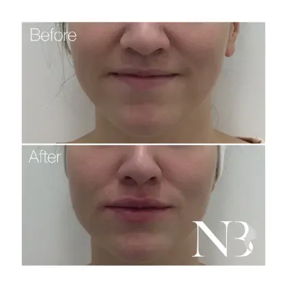 Before & Afters Dr Natasha 4