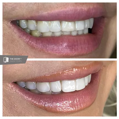 Kristina 9 Teeth Side