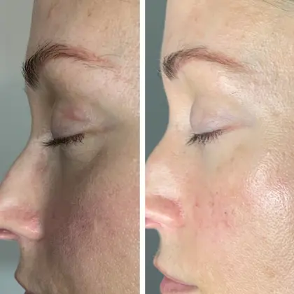 Beautifeye Before And After