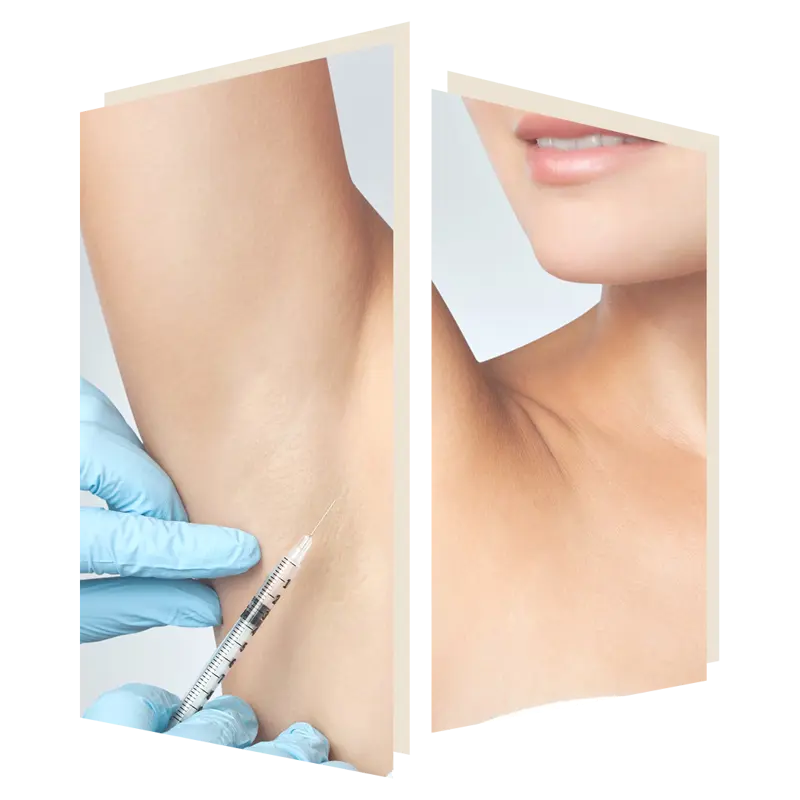 Treat excessive sweating with botox at the door w4