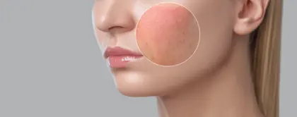 Rosacea