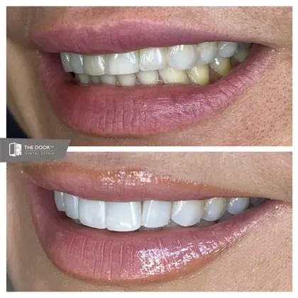 Kristina 8 Teeth Side