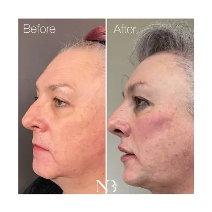 Before & Afters Dr Natasha 5