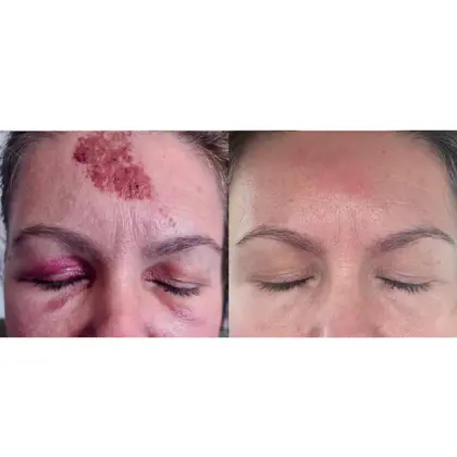 Before And After Red, NIR 9 Session 9 Days