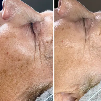 24K Gold Facial Before And After