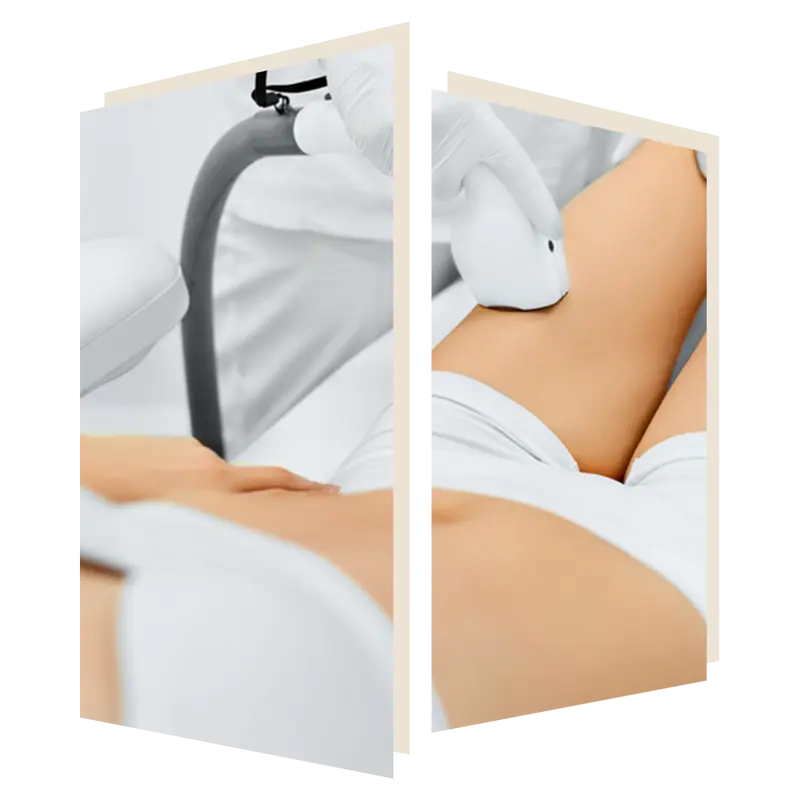 Ingrown Hairs treatable with Laser Hair Removal