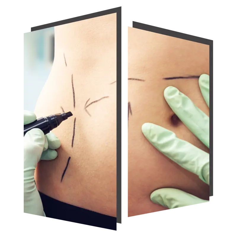 BodyTite treatable areas