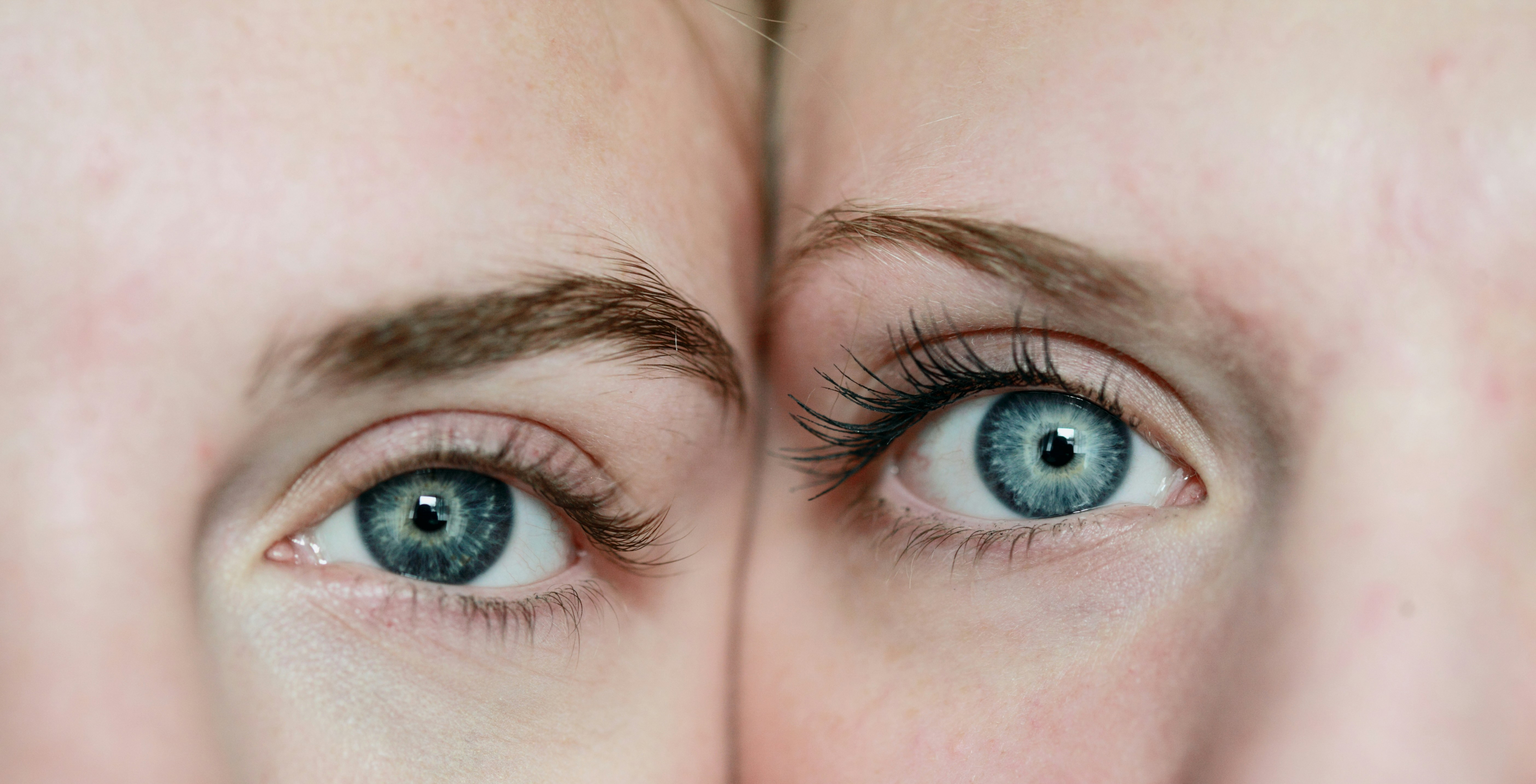 Upper Blepharoplasty