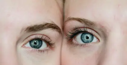 Upper Blepharoplasty