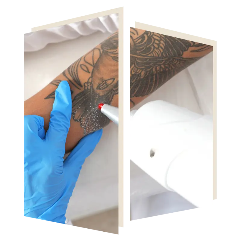 Laser Tattoo Removal at The Door w4