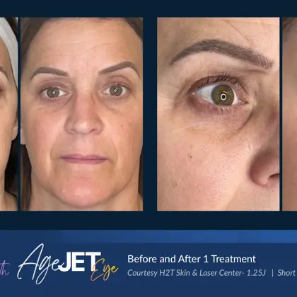 Agejet Before And Aftersagejet Smooth And Eye H2T Skin Laser
