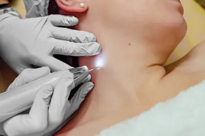 Cryo Skin Tag Removal