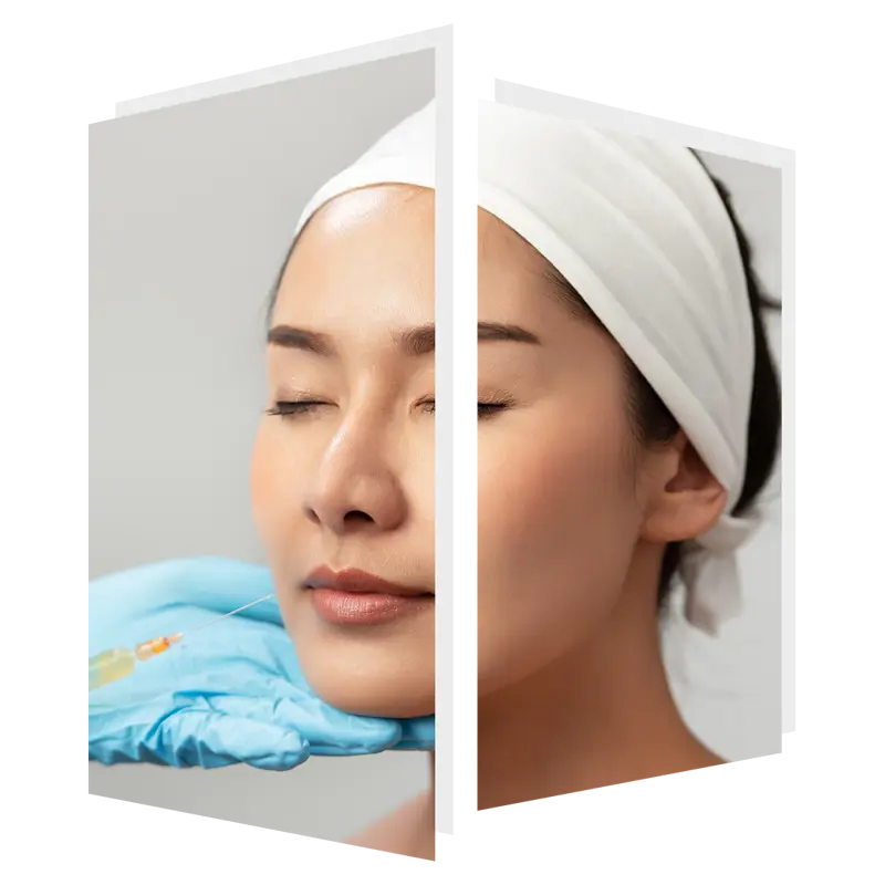 Dermal fillers at The Door W4 in Chiswick