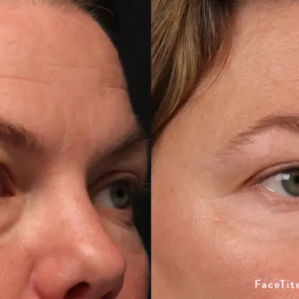 MC FTM8 2D Upperface