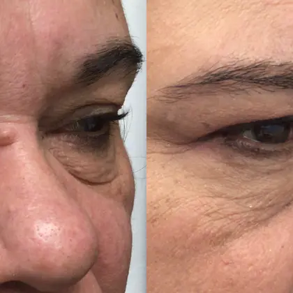 SF Morpheus8 2A Periorbital