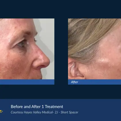 Agejet B&A Hayes Valley Medical Agejet Eye Female 2