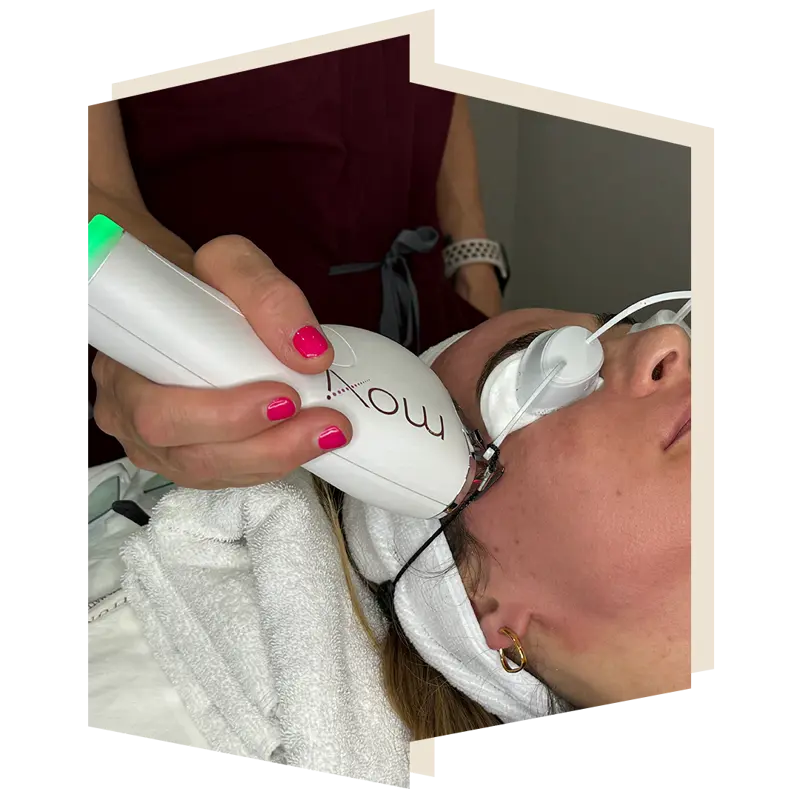Moxi Laser by Sciton at The Door W4 for Skin Rejuvenation