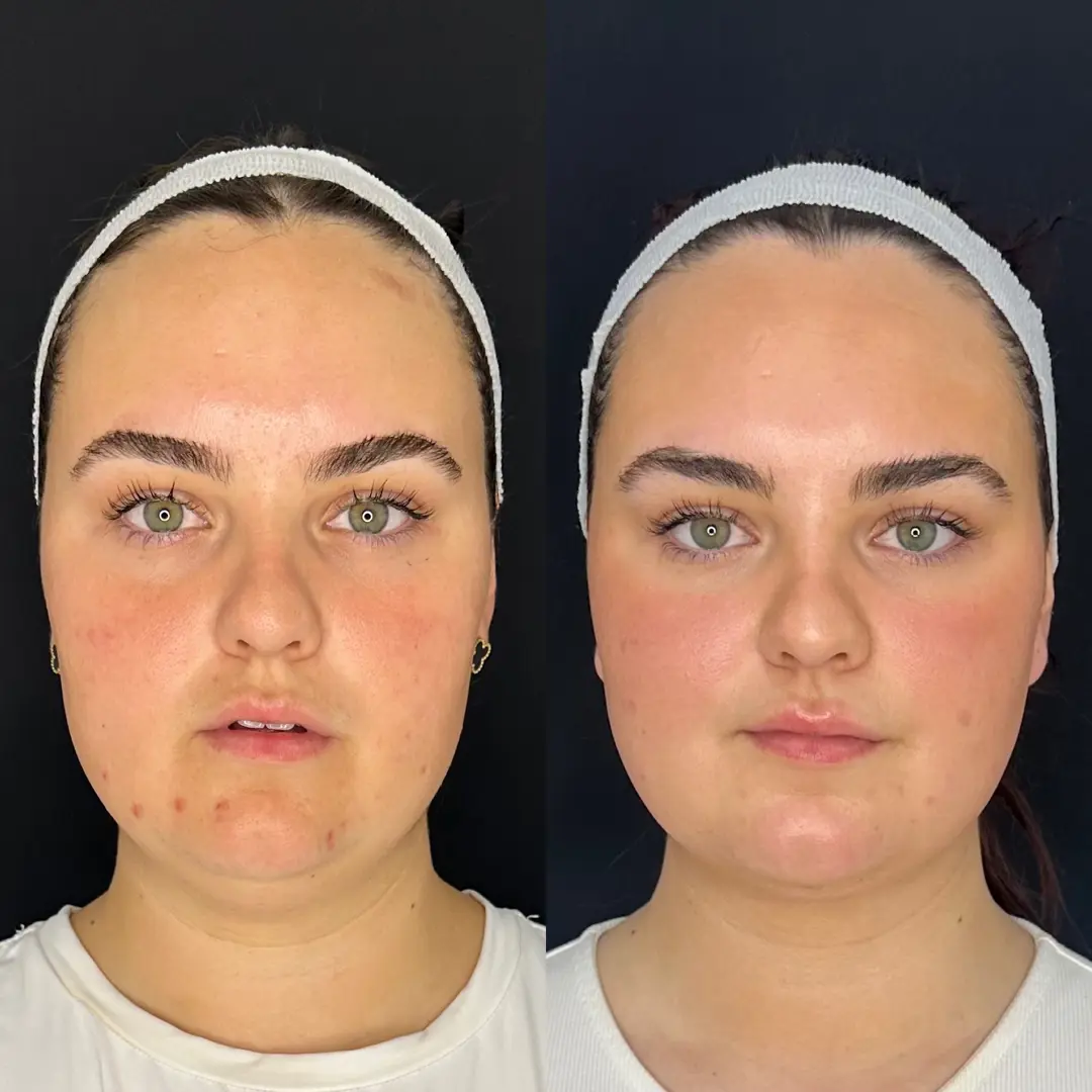 Sculpting Confidence: Molly's FaceTite Journey with Miss Natasha Berridge at The Door W4