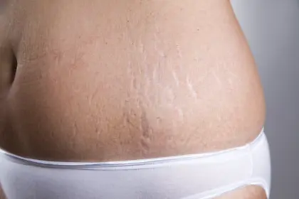Stretch Marks