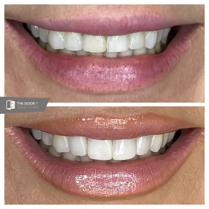 Kristina 7 Teeth Front