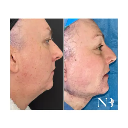 Before & Afters Dr Natasha 9