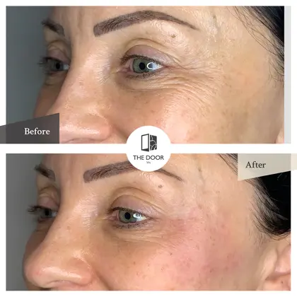 Eye Rejuvenation 2 Before And Afters Copy 2