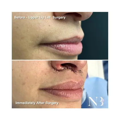 Before & Afters Dr Natasha 14