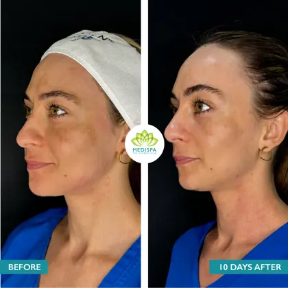 Before And After CORINA Moxi And BBL Heroic 02