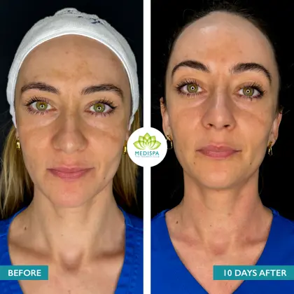 Before And After CORINA Moxi And BBL Heroic 03