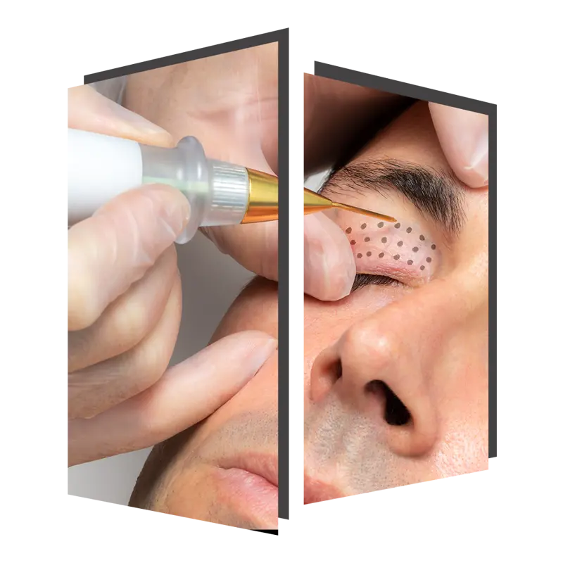 Plexr Plasma eye lid rejuvenation treatment at The Door w4